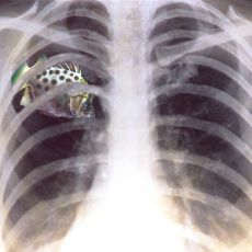 imagen obra de autor leo tena radiografía pecho con pez dentro